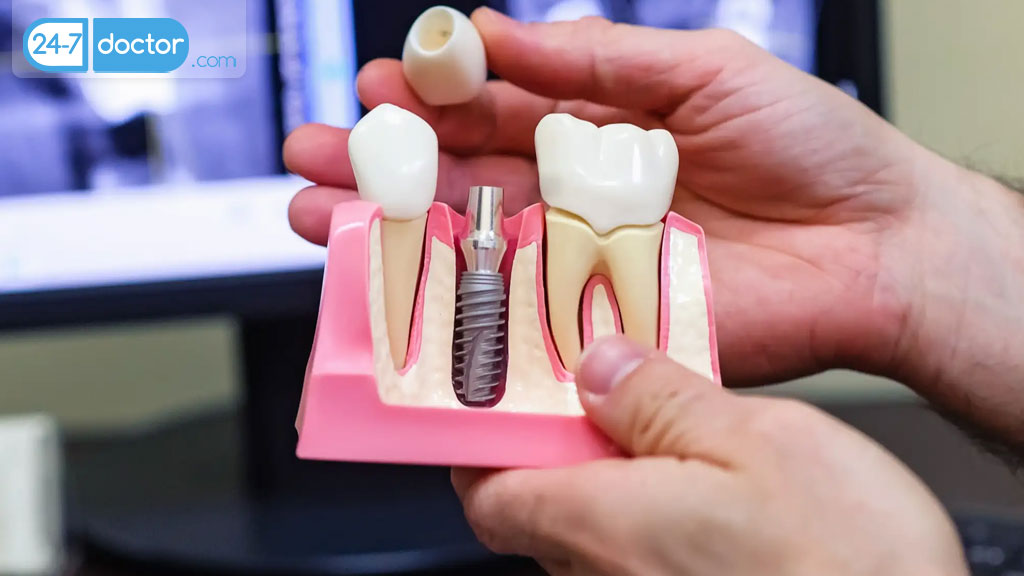 انواع ایمپلنت دندان کدام است؟