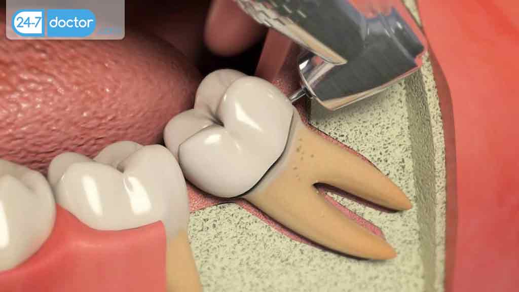 جراحی دندان عقل در شیراز